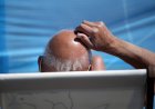 Forget GLP-1 stocks, baldness drugs are Wall Street’s next goldmine